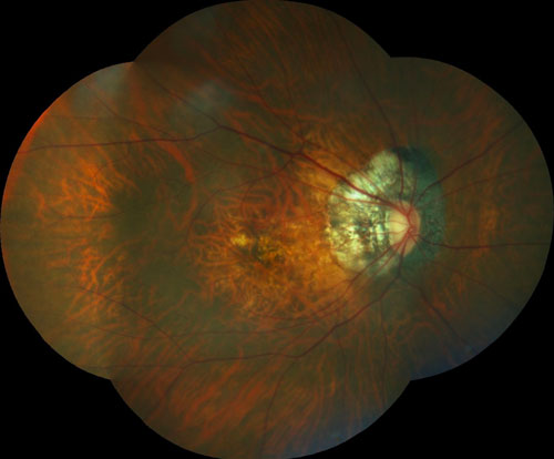 Tractional Maculopathy