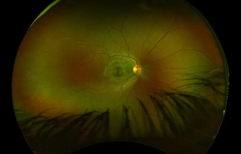 Demyelinating Optic Neuropathy: Beyond Multiple Sclerosis