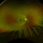 Demyelinating optic neuropathy
