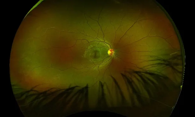 Demyelinating Optic Neuropathy: Beyond Multiple Sclerosis