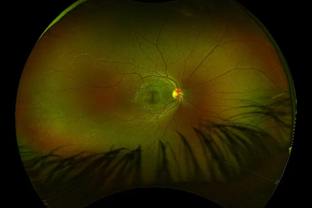 Demyelinating optic neuropathy