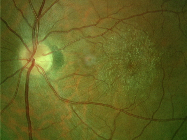 Epiretinal Membrane
