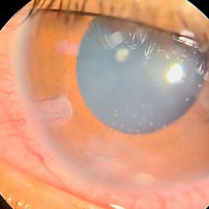 Keratic precipitates adjacent to an anterior chamber granuloma in trematode-associated uveitis