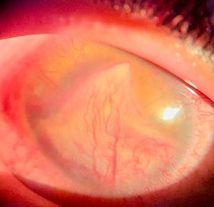 Large anterior chamber granuloma occupying the lower two-thirds of the anterior chamber in trematode-associated uveitis