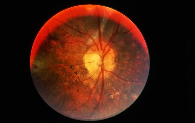 Fundus appearance of acute Vogt-Koyanagi-Harada disease with multifocal serous retinal detachments