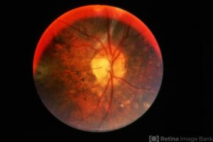 VKH Disease