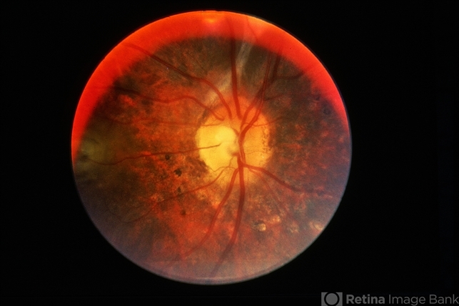 VKH Disease: What Modern Imaging Has Taught Us
