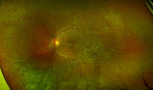 Indocyanine green angiography of VKH showing multiple hypofluorescent dark dots