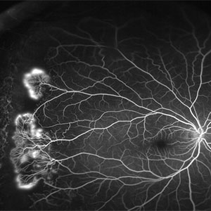 Leaky Vessels on Angiography: Not Every Case Is DR.