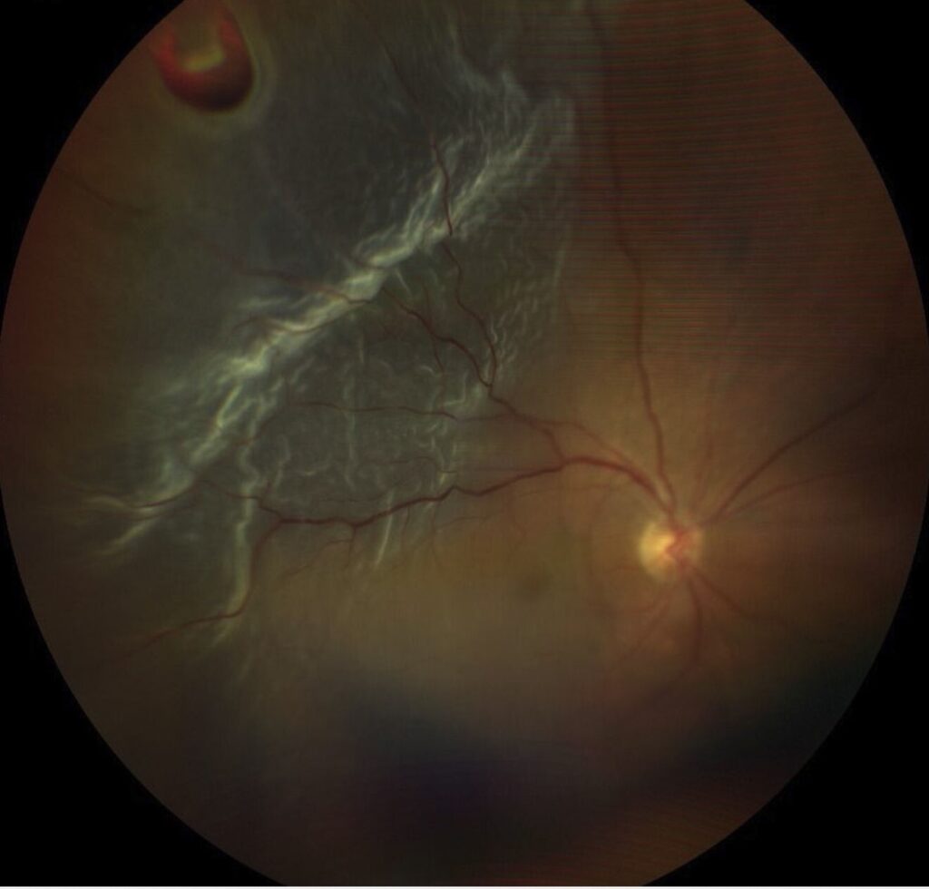 Iatrogenic Macular