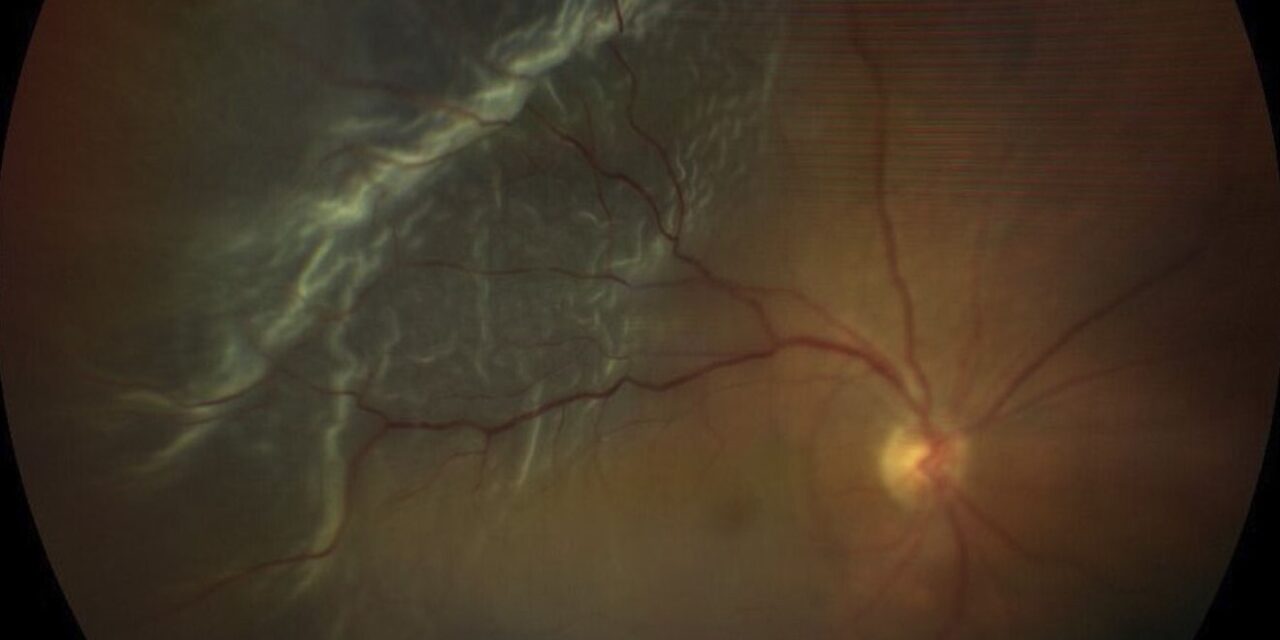 Iatrogenic Macular Defects During Vitreoretinal Surgery