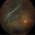 Iatrogenic Macular