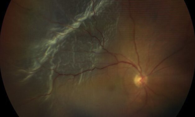 Iatrogenic Macular Defects During Vitreoretinal Surgery