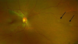 Demyelinating optic neuropathy