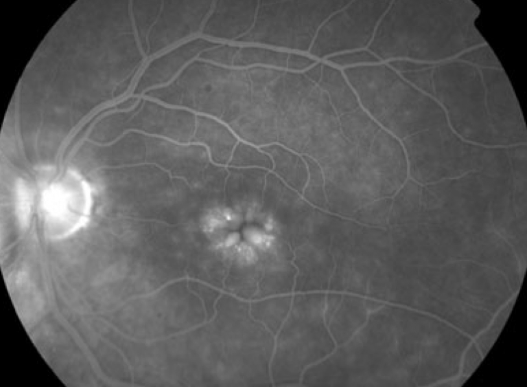 Leaky Vessels on Angiography