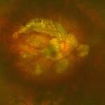 Tractional Maculopathy