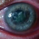 Keratitis