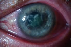 Why Some Keratitis Cases Fail Treatment: Hidden Clinical Pitfalls