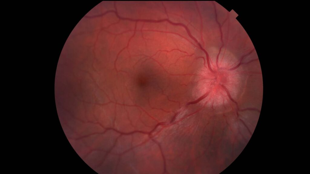 Demyelinating optic neuropathy