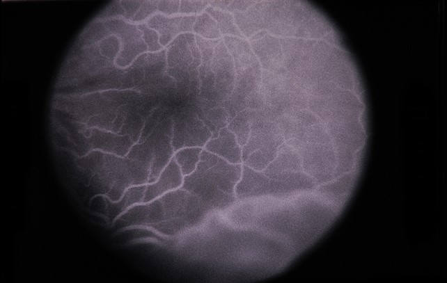 Resolution of subretinal fluid on OCT after corticosteroid therapy in VKH