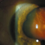 Suprachoroidal Hemorrhage