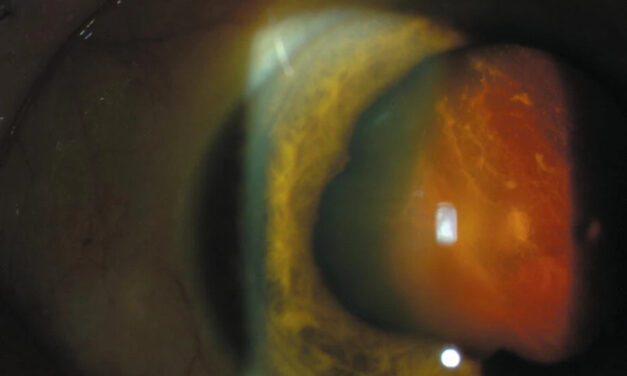 Suprachoroidal Hemorrhage in Pediatric Glaucoma Surgery
