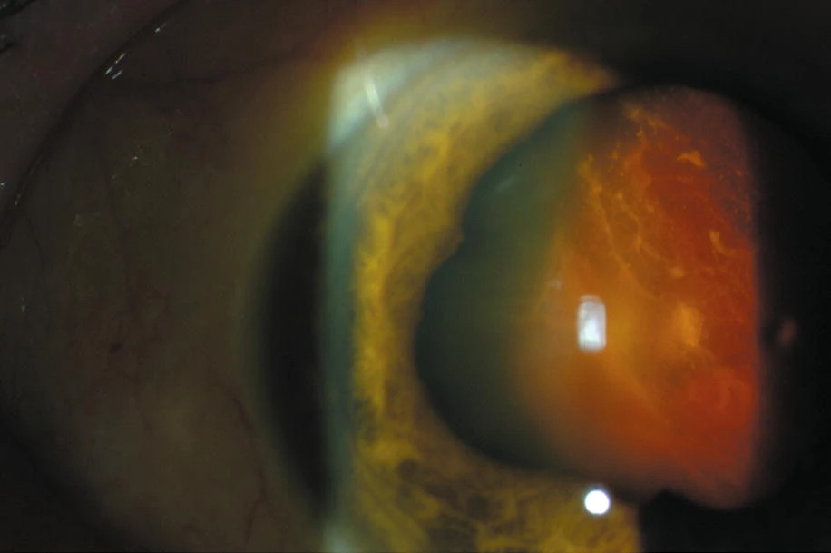 Suprachoroidal Hemorrhage in Pediatric Glaucoma Surgery