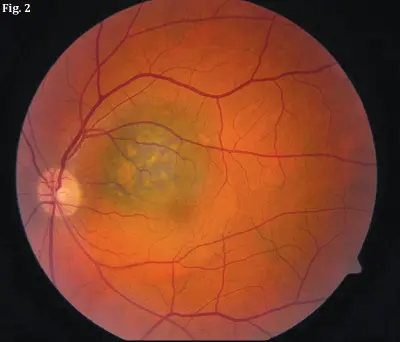 Choroidal nevus vs small melanoma: flat amelanotic choroidal nevus at the posterior pole with overlying drusen, a reassuring low-risk feature