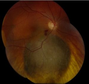 Choroidal Nevus vs Small Melanoma: Applying the TFSOM Risk Factors