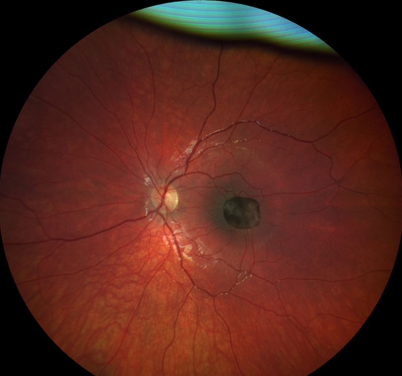 Combined Hamartoma of the Retina and RPE - charcoal macular lesion involving the fovea Colour fundus photograph of combined hamartoma of the retina and RPE showing a dark charcoal, ill-defined pigmented lesion in the central macula with foveal involvement and dragged juxtapapillary vessels.