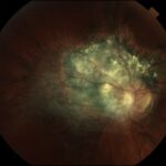Combined Hamartoma of the Retina and RPE: a juxtapapillary grey-white glial veil overlying the posterior pole with tortuous, dragged retinal vessels.