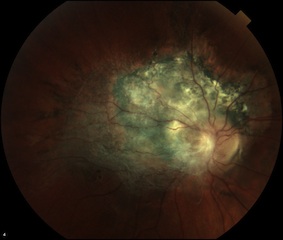 Combined Hamartoma of the Retina and RPE: Clinical Features and Imaging