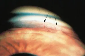 Fuchs Heterochromic Iridocyclitis