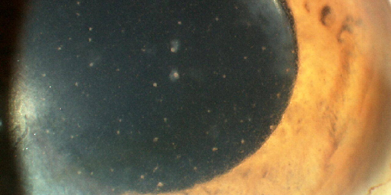 Fuchs Heterochromic Iridocyclitis: The Uveitis That Doesn’t Look Like Uveitis