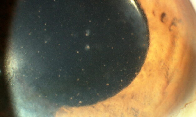 Fuchs Heterochromic Iridocyclitis: The Uveitis That Doesn’t Look Like Uveitis
