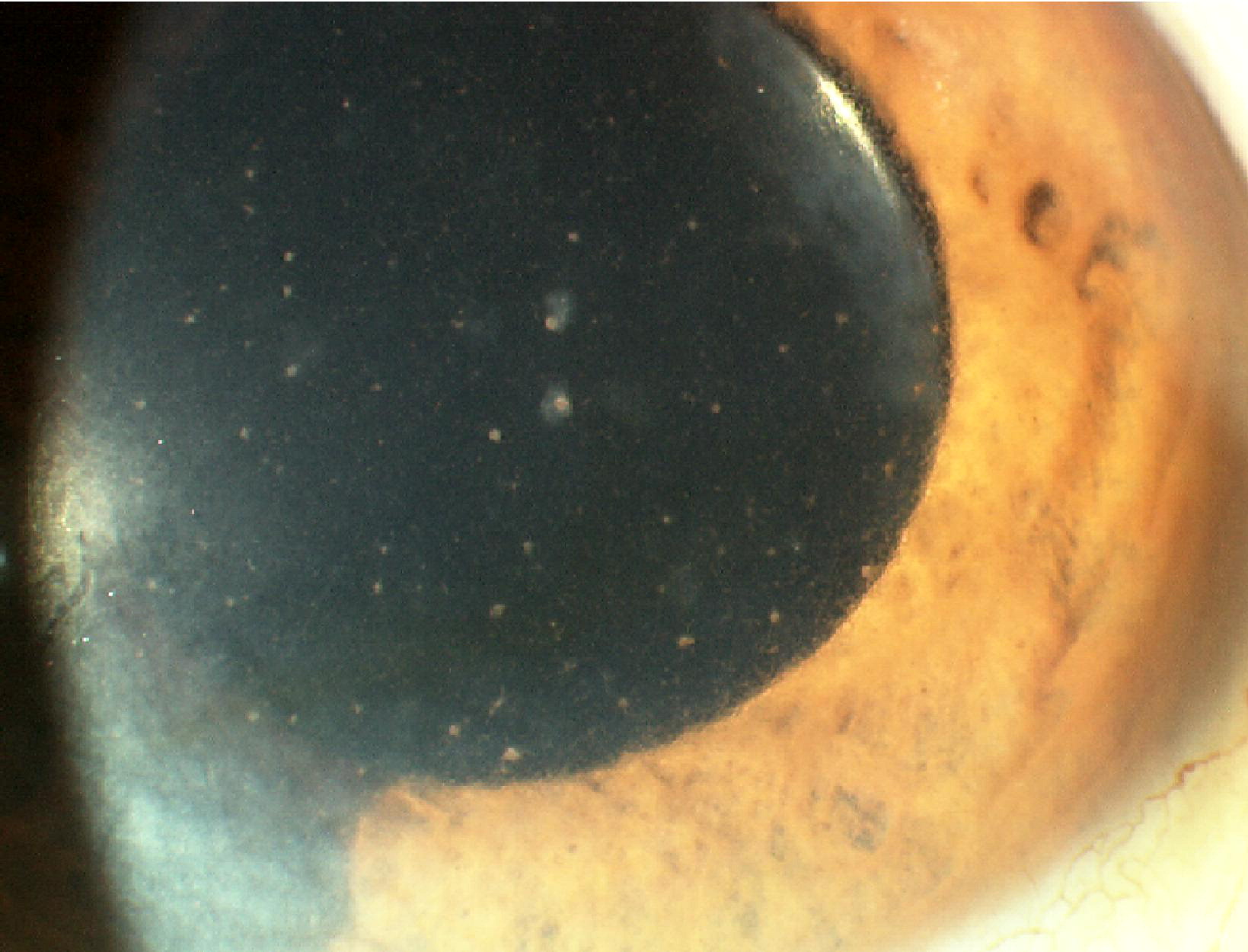 Diffuse small stellate keratic precipitates scattered across the entire corneal endothelium with iris stromal atrophy in Fuchs uveitis