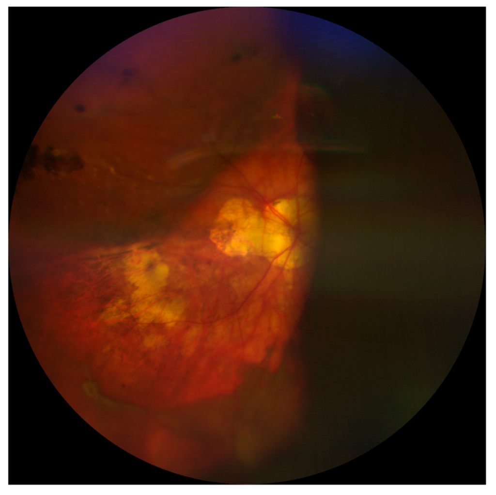 Suprachoroidal Hemorrhage
