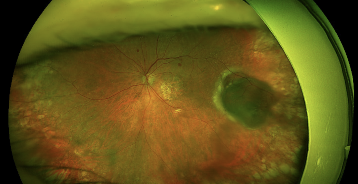 Peripheral Exudative Hemorrhagic Chorioretinopathy (PEHCR): A Melanoma Mimic