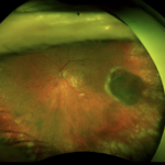 Peripheral Exudative Hemorrhagic Chorioretinopathy (PEHCR): Optos ultra-widefield colour fundus of the left eye showing an elevated dark peripheral chorioretinal lesion simulating a choroidal tumour