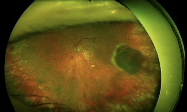 Peripheral Exudative Hemorrhagic Chorioretinopathy (PEHCR): A Melanoma Mimic