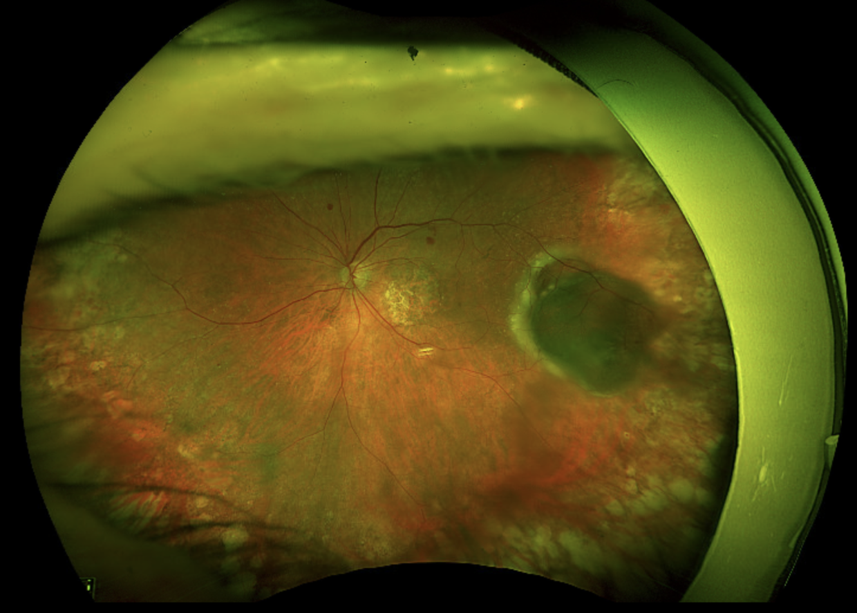 Peripheral Exudative Hemorrhagic Chorioretinopathy (PEHCR) - Optos widefield fundus Peripheral Exudative Hemorrhagic Chorioretinopathy (PEHCR): Optos ultra-widefield colour fundus of the left eye showing an elevated dark peripheral chorioretinal lesion simulating a choroidal tumour