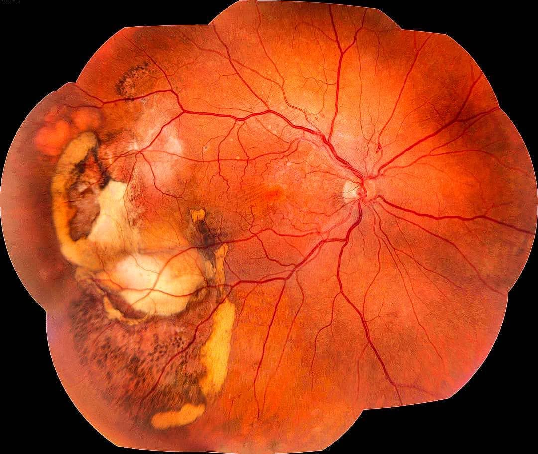 Peripheral Exudative Hemorrhagic Chorioretinopathy (PEHCR) - subretinal haemorrhage and lipid exudate Peripheral Exudative Hemorrhagic Chorioretinopathy (PEHCR): widefield fundus montage showing a peripheral lesion with sub-retinal haemorrhage, lipid exudation and pigment, mimicking a choroidal melanoma