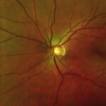 Schwartz-Matsuo Syndrome: dilated fundus photograph of the optic disc and retinal vessels during the posterior segment examination needed to detect a peripheral retinal detachment