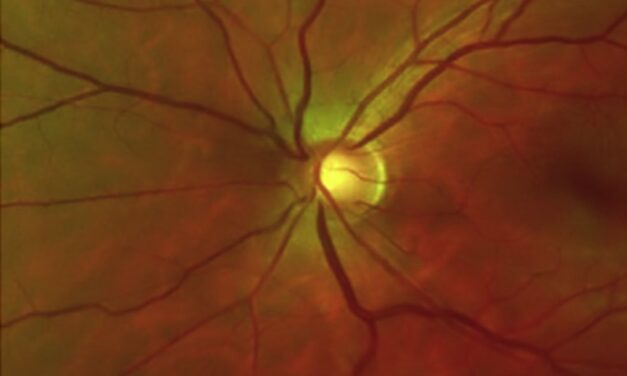 Schwartz-Matsuo Syndrome: When Retinal Detachment Raises the Pressure