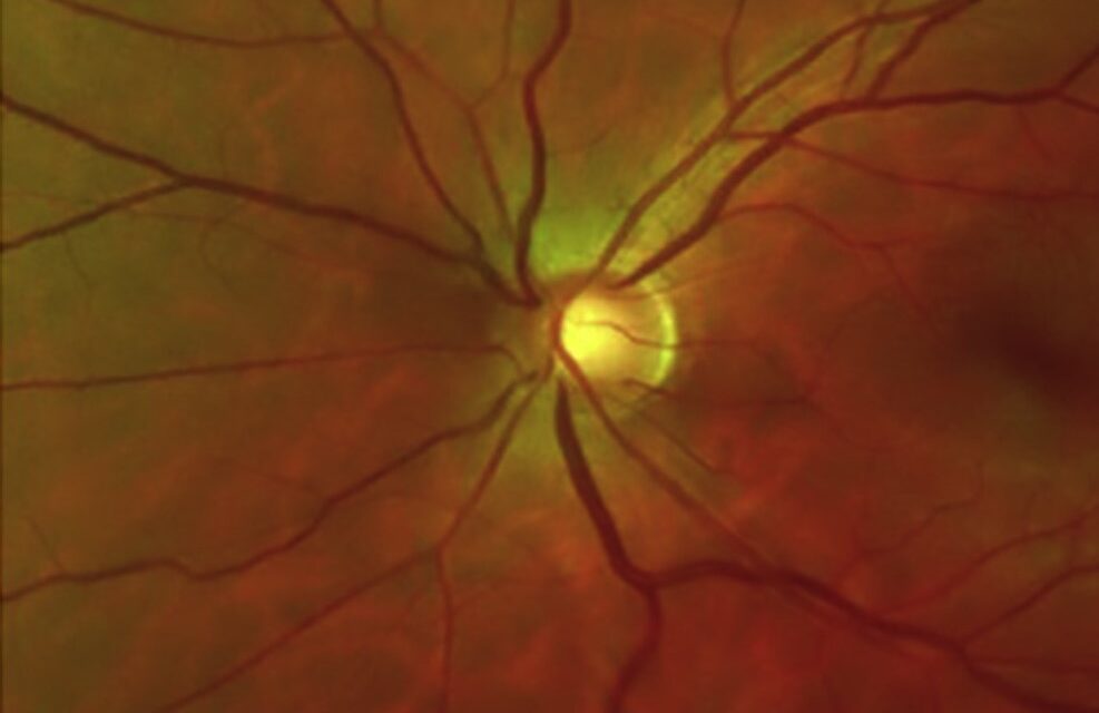 Schwartz-Matsuo Syndrome: When Retinal Detachment Raises the Pressure