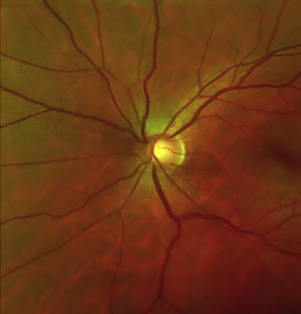 Schwartz-Matsuo Syndrome: dilated fundus photograph of the optic disc and retinal vessels during the posterior segment examination needed to detect a peripheral retinal detachment