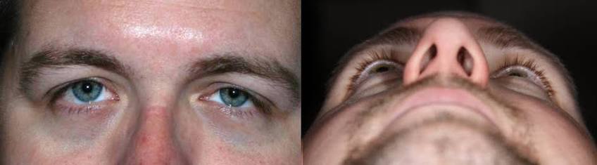 Silent Sinus Syndrome: unilateral enophthalmos with deep superior sulcus, and worm's-eye view demonstrating posterior displacement of the affected globe
