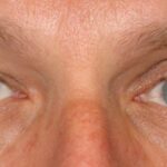 Silent Sinus Syndrome: painless unilateral enophthalmos with a deepened upper lid sulcus and asymmetric palpebral fissure