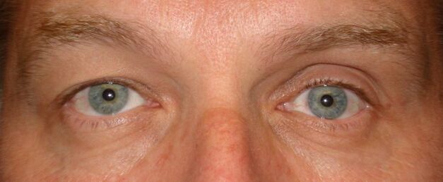 Silent Sinus Syndrome: A Subtle Cause of Enophthalmos