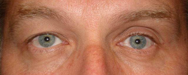 Silent Sinus Syndrome: A Subtle Cause of Enophthalmos